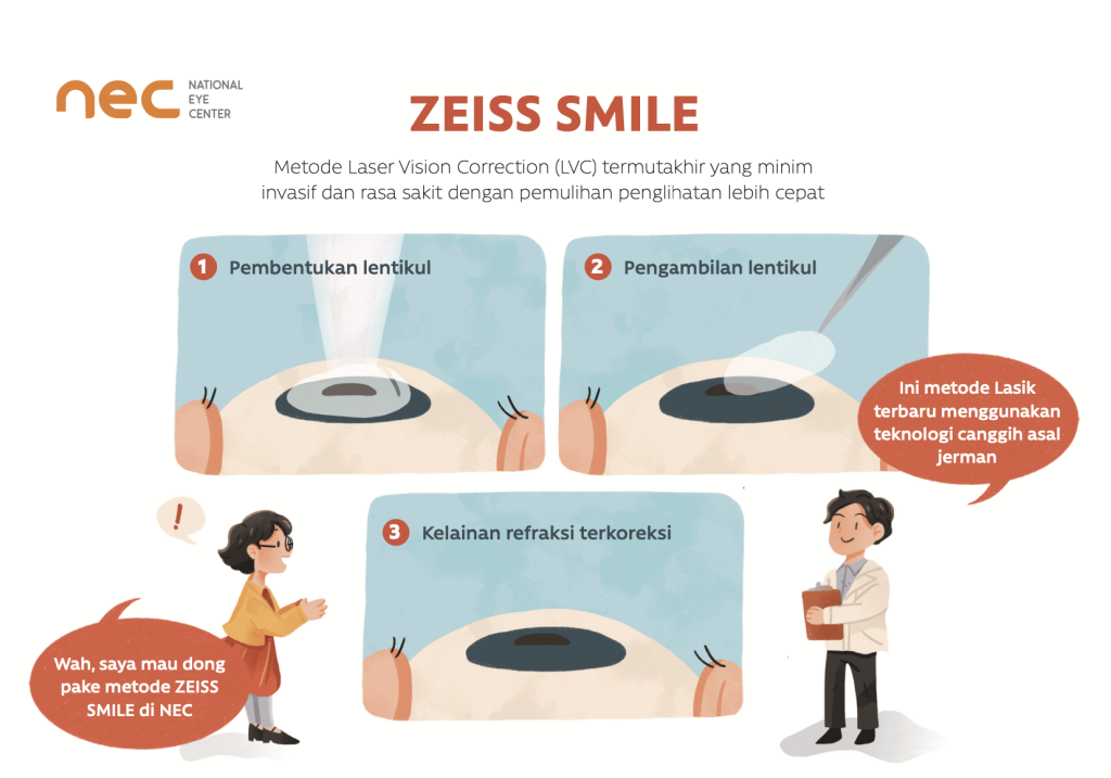 proses metode zeiss smile lasik surabaya National eye cetnter