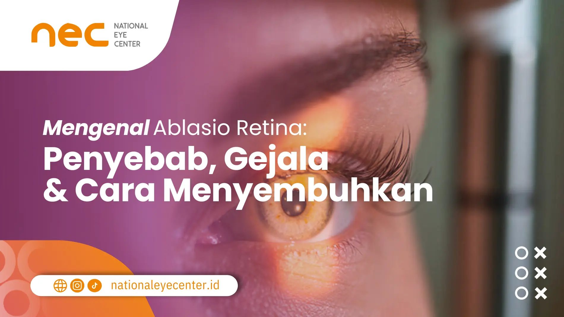 Mengenal Ablasio Retina Penyebab, Gejala, dan Cara Menyembuhkan