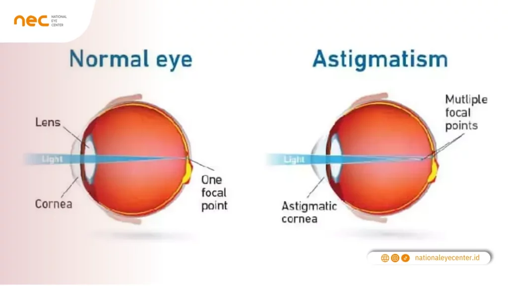 Pengertian dan Penyebab Kacamata Silinder atau Astigmatisme