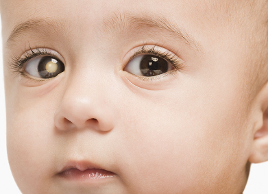 retinoblastoma