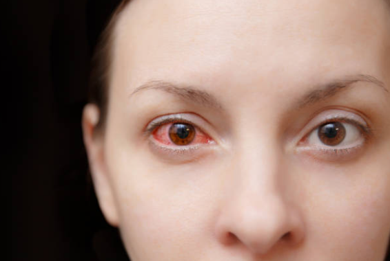 Infeksi Karena Softlens : Mata Merah