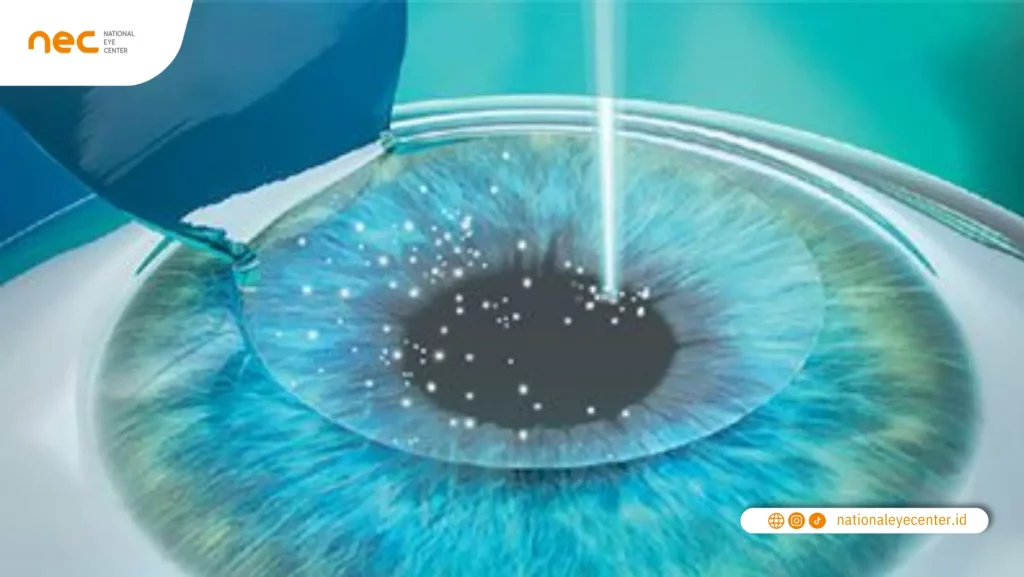 Pengertian Lasik