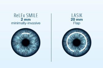 ReLEx SMILE (Konsultasi Lasik) 