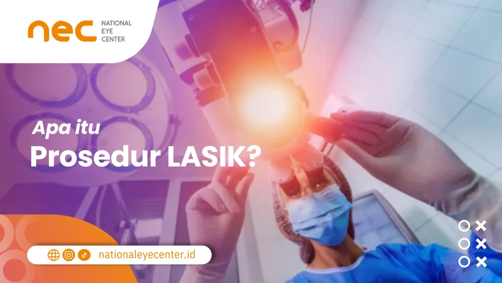 Prosedur Lasik