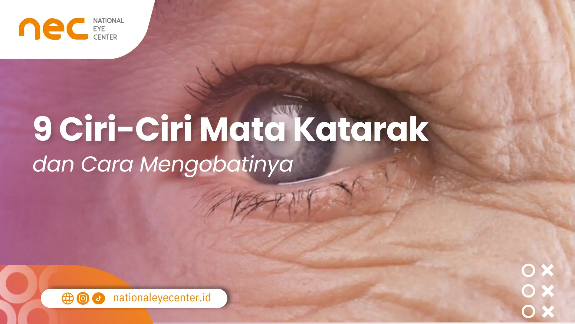 9 Ciri-Ciri Mata Katarak dan Cara Mengobatinya