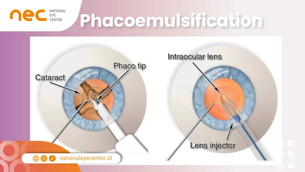 Operasi Mata Katarak: Phacoemulsification