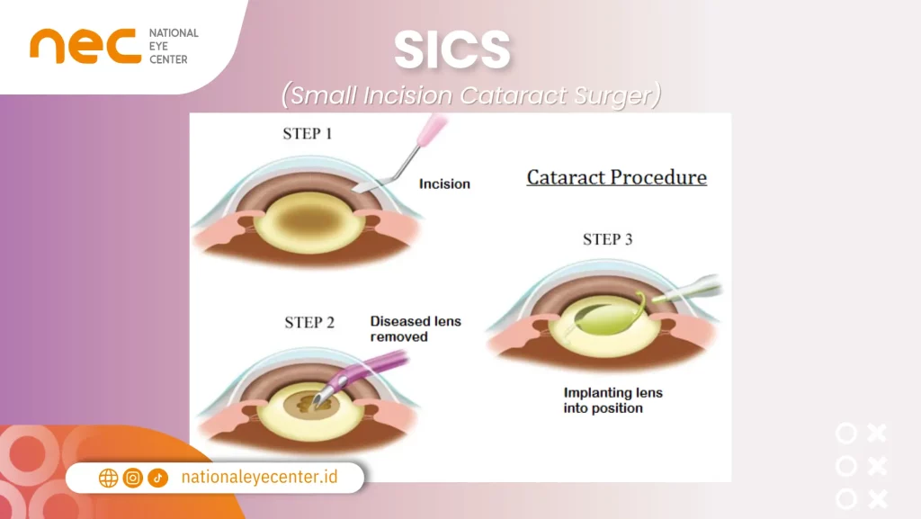 Operasi Mata Katarak: SICS (Small Incision Cataract Surgery)