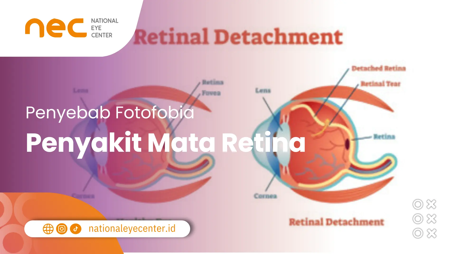 Penyebab fotofobia: Penyakit mata retina
