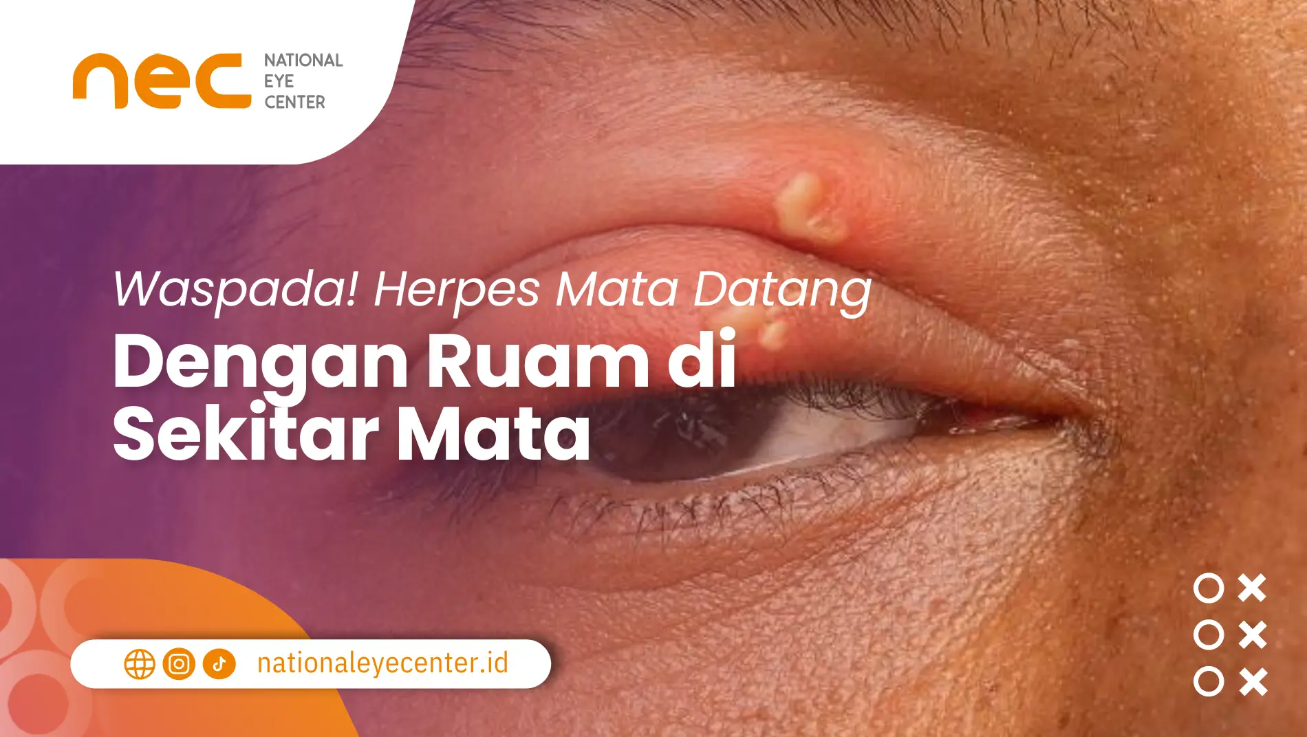 Waspada! Herpes Mata Datang Dengan Ruam di Sekitar Mata