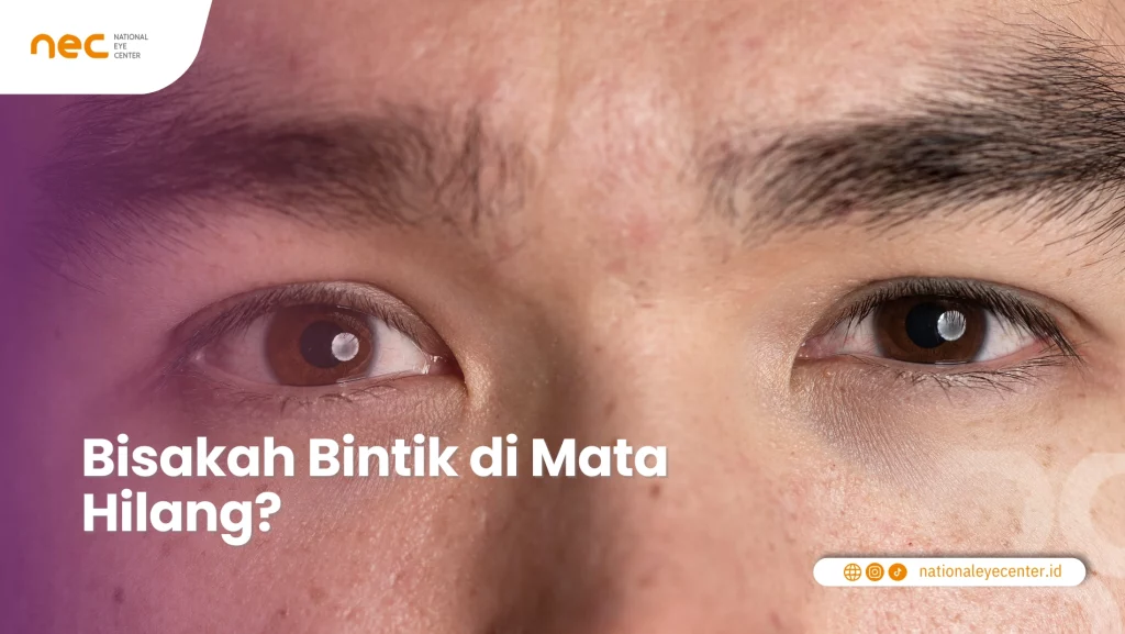 Cara Menghilangkan Bintik Hitam di Mata