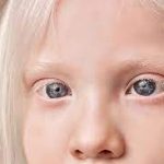 Penyakit Mata Pada Albino