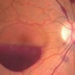 pendarahan retina