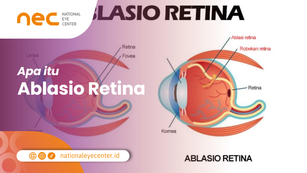 Apa Itu Ablasio Retina