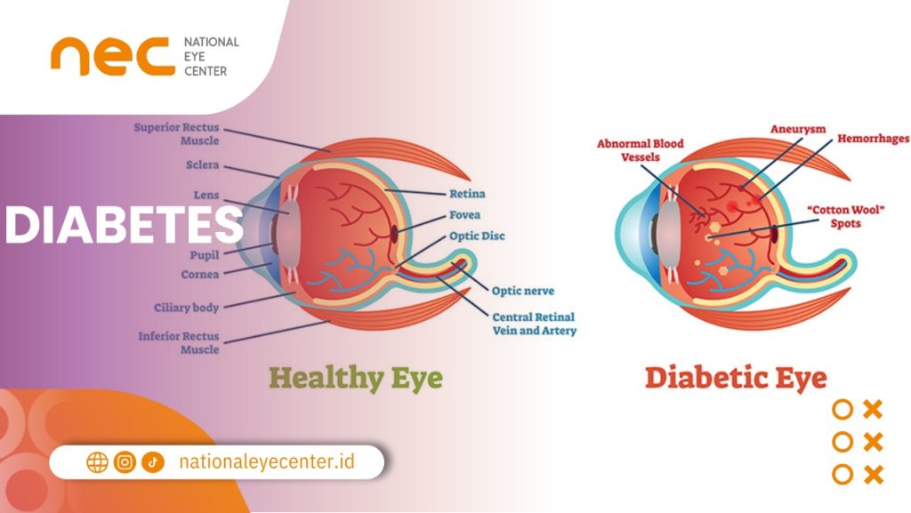 Salah satu kondisi yang memengaruh kilatan cahaya di samping mata, yakni diabetes.