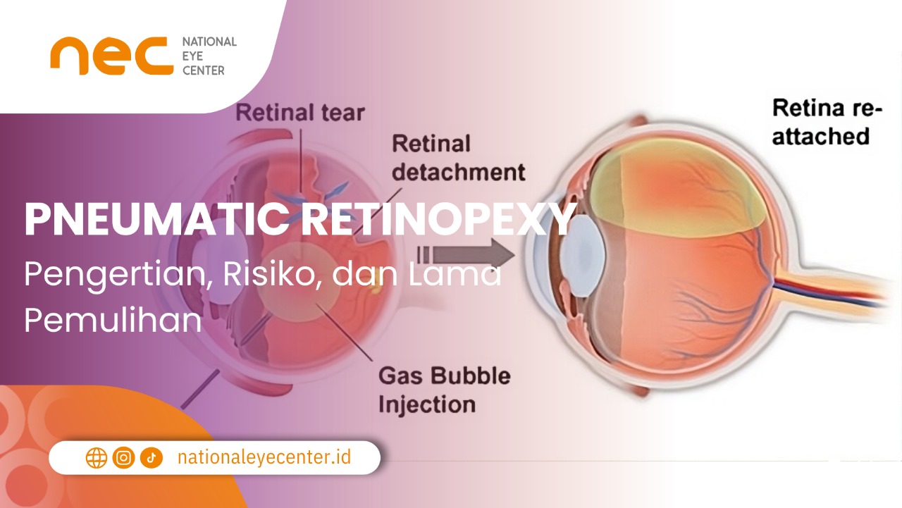 Gambar utama artikel Pneumatic Retinopexy