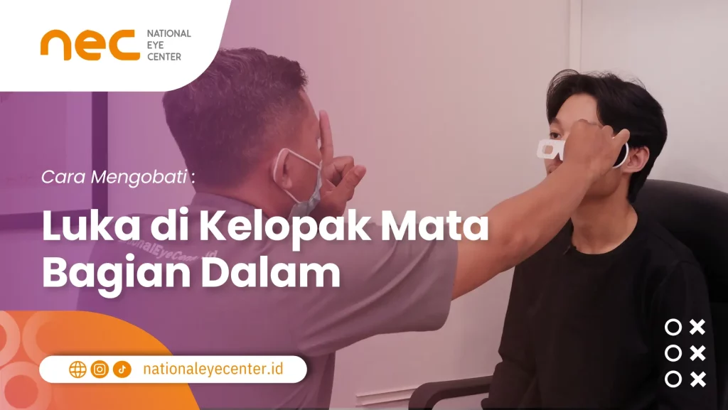 Cara Mengobati Luka di Kelopak Mata Bagian Dalam