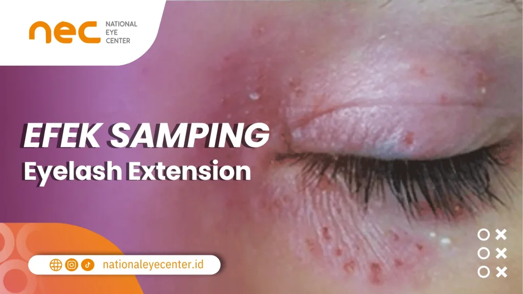 Gambar menunjukkan salah satu efek samping eyelash extension.