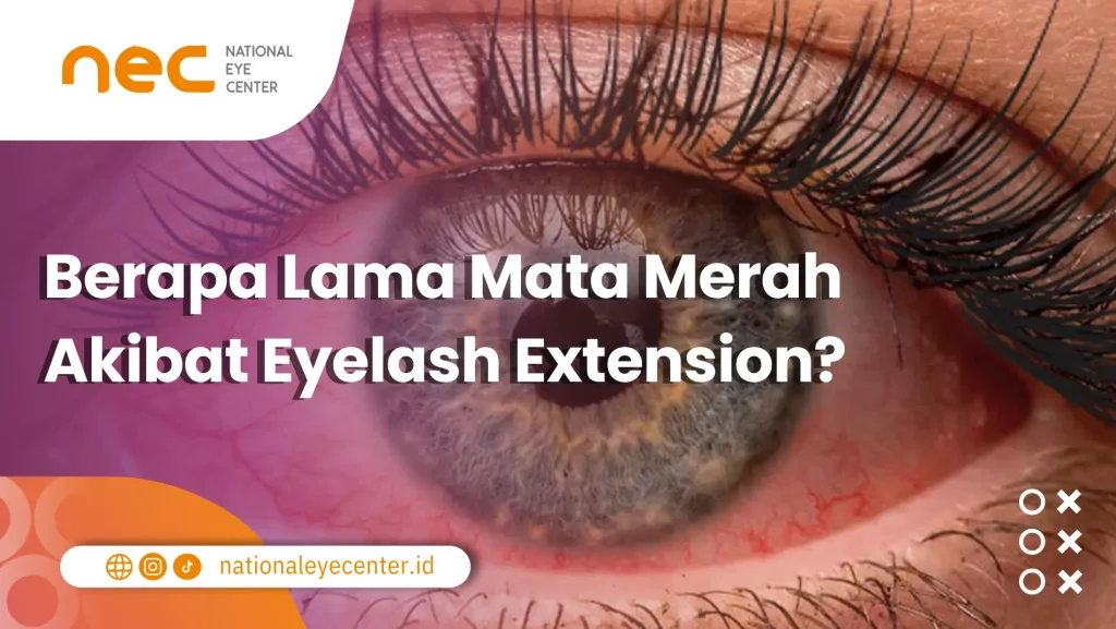 Gambar menunjukkan mata merah yang merupakan salah satu efek samping eyelash extension.