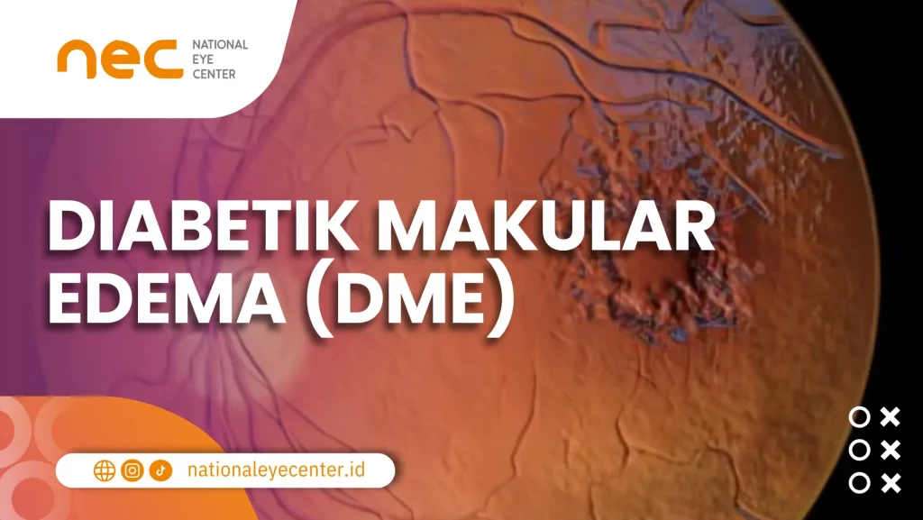 Salah satu gangguan mata yang disebabkan oleh diabetes, yaitu Diabetik Makular Edema (DME).