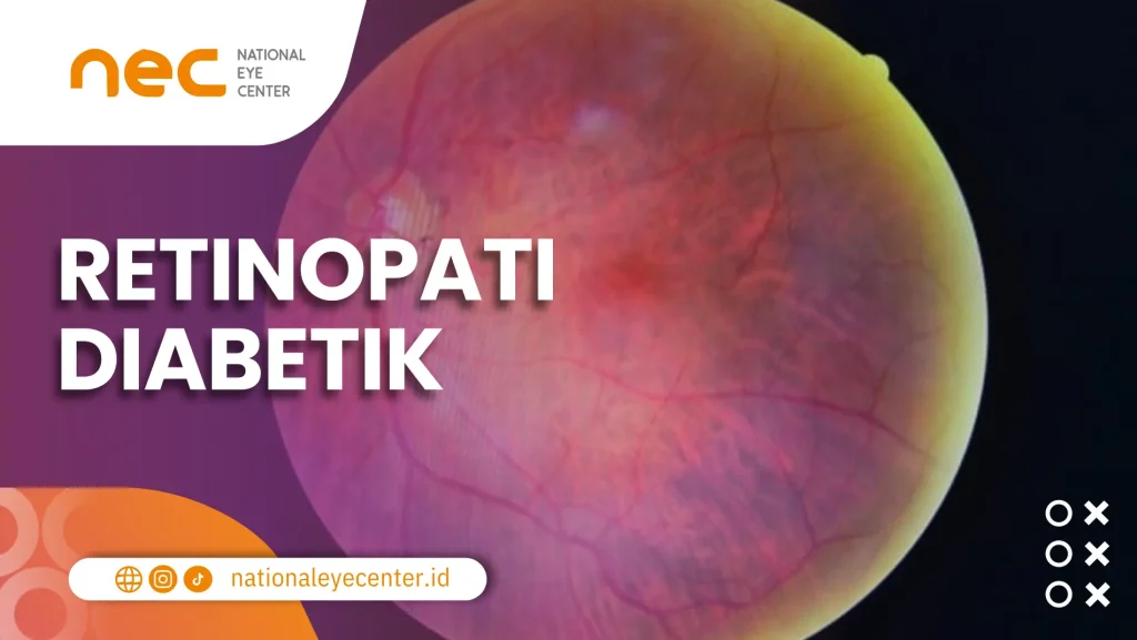 Salah satu gangguan mata yang disebabkan oleh diabetes, yaitu Retinopati Diabetik.