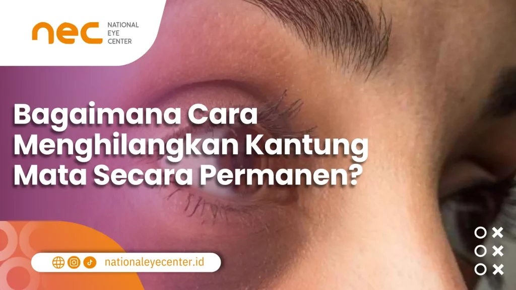 Gambar untuk "Bagaimana Cara Menghilangkan Kantung Mata Secara Permanen?"