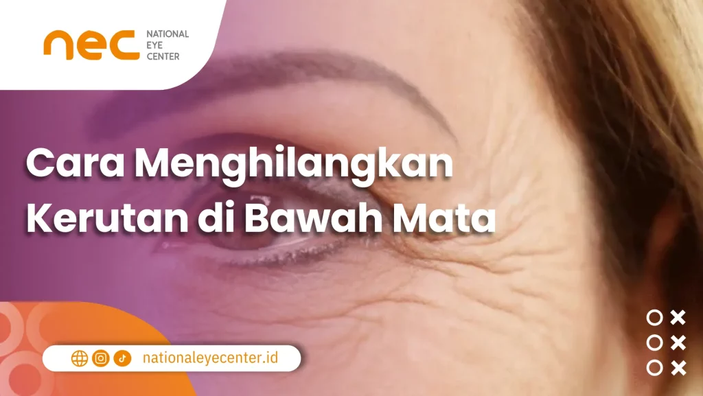 Cara Menghilangkan Kerutan di Bawah Mata