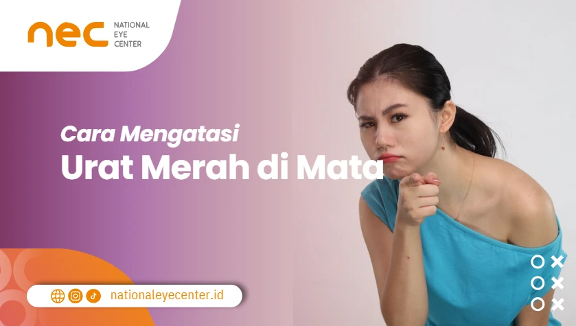 Cara mengatasi urat merah dimata