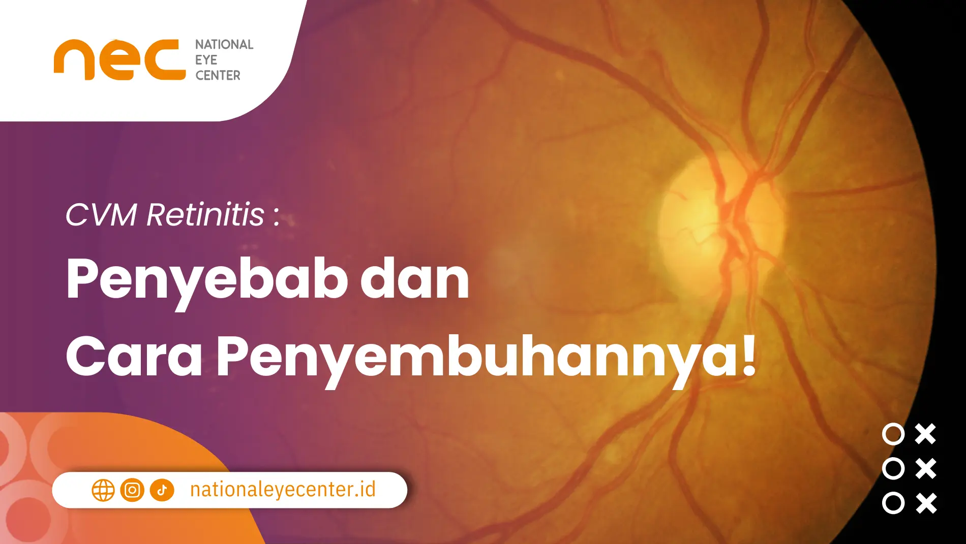 cmv retinitis