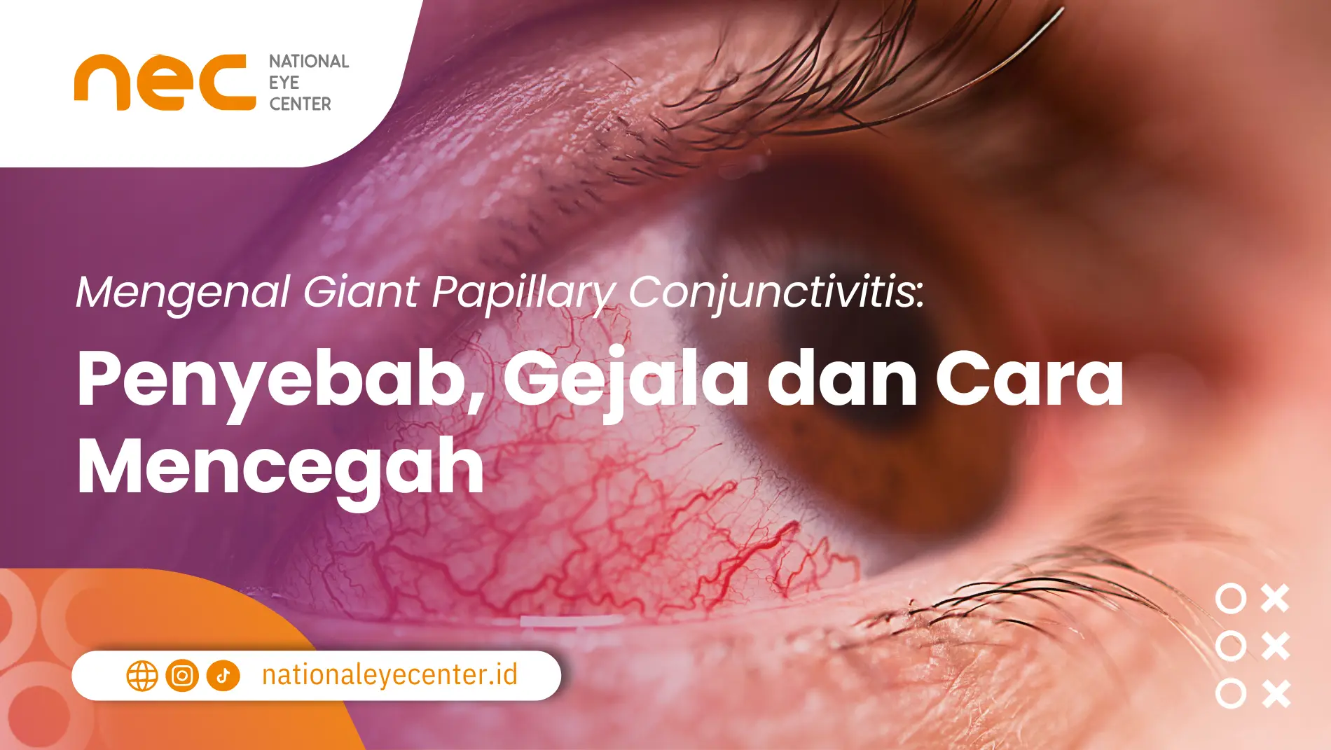 giant papillary conjunctivitis