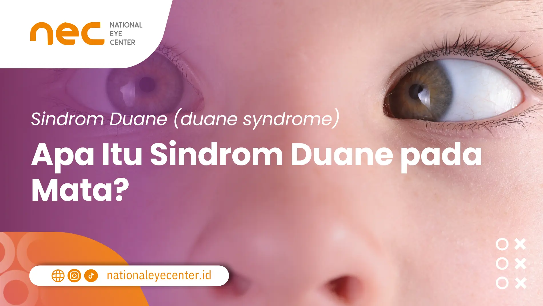 sindrom duane (duane syndrome)